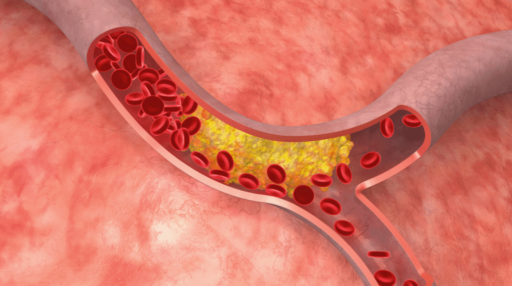 Darstellung einer Arterie mit Plaqueablagerung und verengtem Gefäßlumen